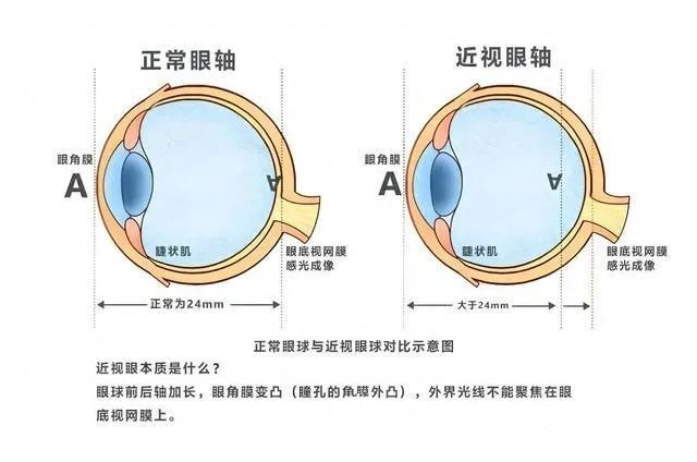 为什么高度近视更容易得白内障？